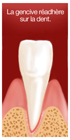 La gencive réadhère sur la dent